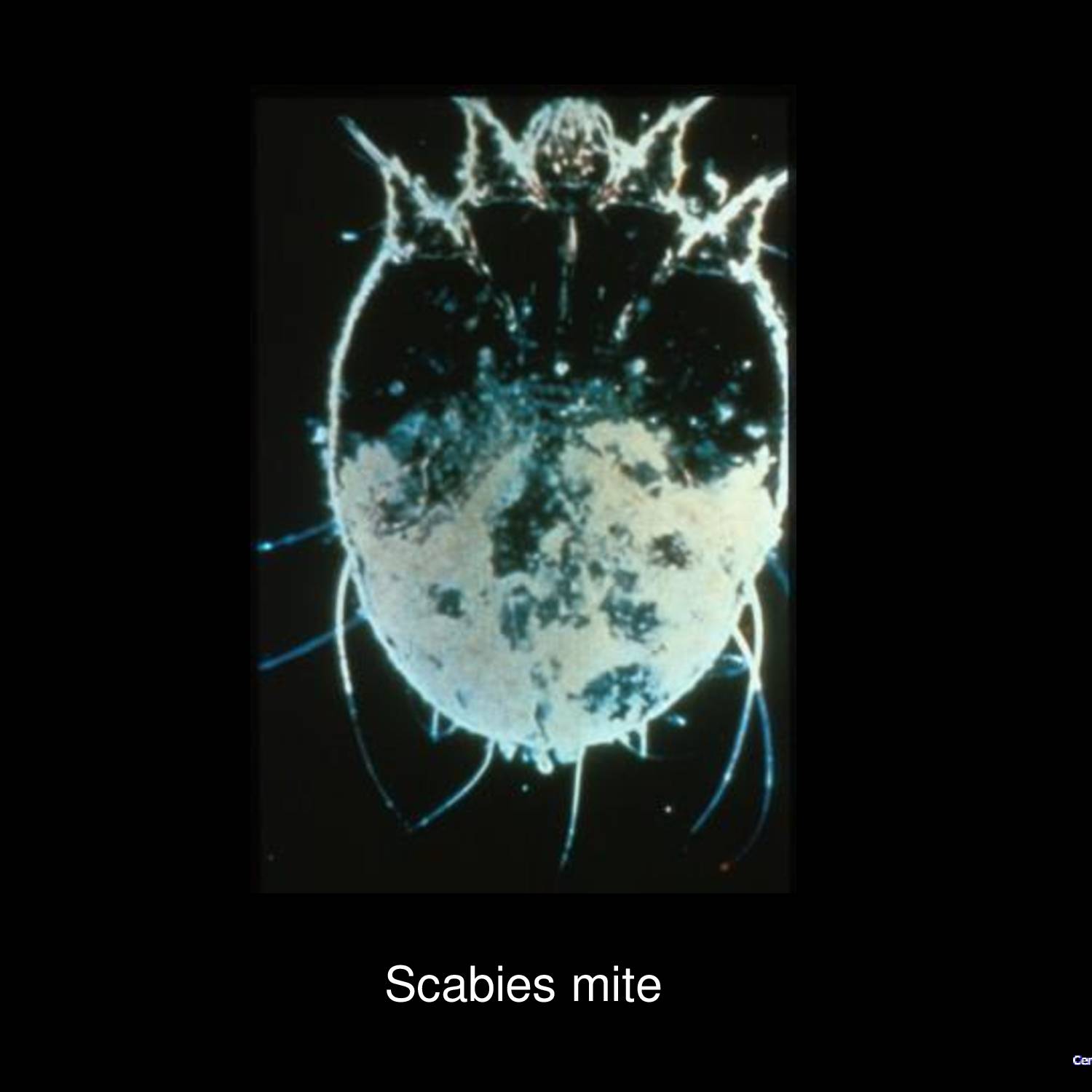 Scabies infestation on wrist showing erythematous papules and burrows with excoriations from intense pruritus typical of Sarcoptes scabiei infection